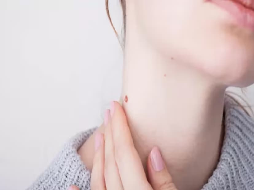 আঁচিল কখন বিপজ্জনক? এইচপিভি অর্থাৎ হিউম্যান প্যাপিলোমাভাইরাস এবং জেনিটালে আঁচিল অনেক ধরনের ক্যানসারের কারণ হতে পারে। এমনকী ডায়াবেটিসের মতো মারণরোগের লক্ষণও হতে পারে আঁচিল। সেক্ষেত্রে শরীরে আচমকা আঁচিল দেখলে ডাক্তারের পরামর্শ নিতে হবে। (প্রতীকী ছবি)