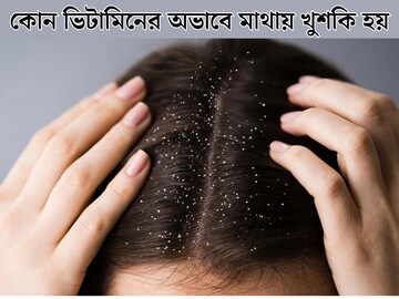 কোন ভিটামিনের অভাবে খুশকিতে ভরে মাথা, জানাচ্ছন পুষ্টিবিদ! রইল বাঁচার সেরা টোটকা!