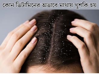 কোন ভিটামিনের অভাবে খুশকিতে ভরে মাথা, জানাচ্ছন পুষ্টিবিদ! রইল বাঁচার সেরা টোটকা!