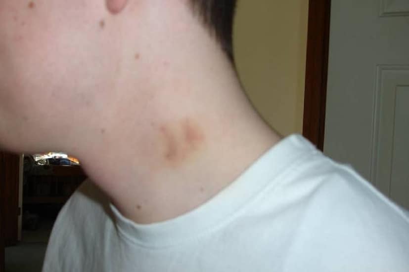 চিকিৎসক সায়নদীপ সমাদ্দারের মতে, ওরাল হার্পিস রয়েছে এমন কোনও ব্যক্তির মাধ্যমে যদি লভ বাইট তৈরি হয়, তাহলে অসুখ ট্রান্সমিটেড হতে পারে সঙ্গী বা সঙ্গিনীর মধ্যেও৷ (প্রতীকী ছবি)