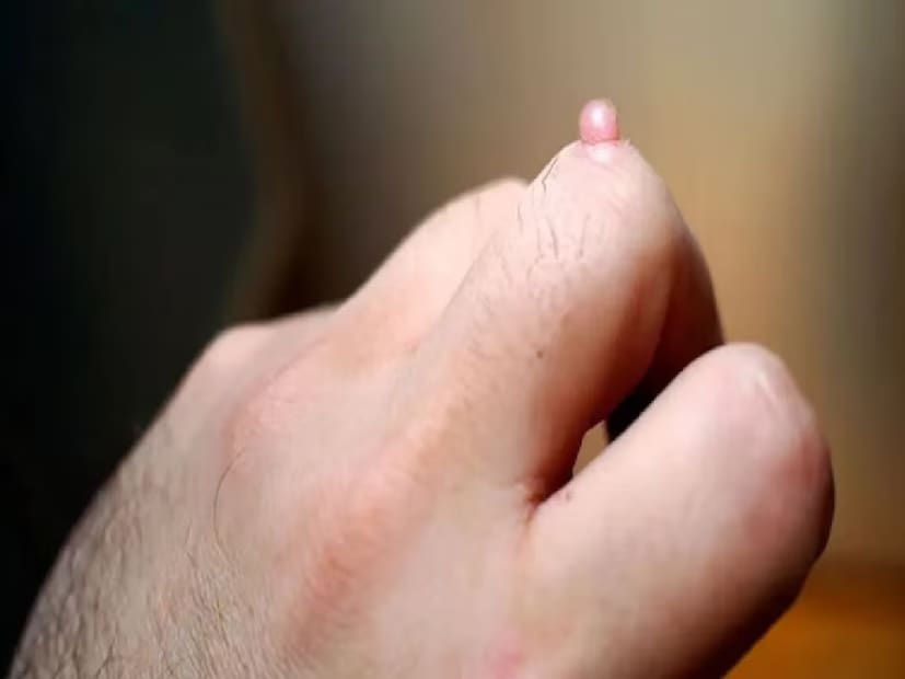 আঁচিলে বিশেষ কোনও ক্ষতি হয় না, তবে এই আঁচিলগুলো যদি শরীরের কোনও কোনও স্থানে দেখা যায় এবং অনেক দিন ধরে থাকে তাহলে তা ক্যানসারের কারণও হতে পারে। এই ধরনের আঁচিলকে উপেক্ষা করা উচিত না। আঁচিল বাড়তে থাকলে চিকিৎসকের পরামর্শ অবশ্যই নিতে হবে। (প্রতীকী ছবি)