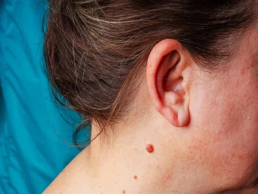 আঁচিলের কারণ কী? হিউম্যান প্যাপিলোমাভাইরাস ত্বকে কাটার মাধ্যমে প্রবেশ করে এবং সংক্রমণ ছড়ায়। একবার এই ভাইরাস শরীরে প্রবেশ করলে অনেক জায়গায় আঁচিল দেখা দিতে পারে। আক্রান্ত ব্যক্তির ব্যক্তিগত জিনিস যেমন তোয়ালে, সাবান, শেভিং কিট বা অন্তর্বাস ব্যবহার করলে ভাইরাল ব্যবহারকারীর শরীরে প্রবেশ করতে পারে। (প্রতীকী ছবি)