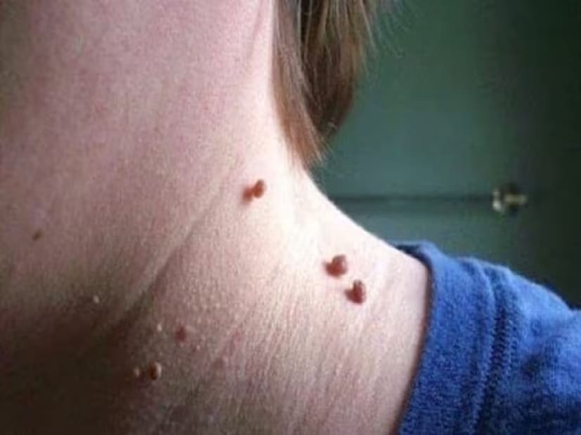 আর এই আঁচিল কোনওভাবে পড়ে গেলে সেই স্থান থেকে প্রবল রক্তপাতও হতে পারে। (প্রতীকী ছবি)