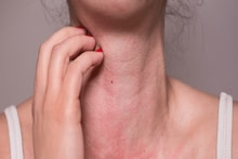 Dry Itching Skin Problem: শীতে ত্বক শুকিয়ে ভিতর থেকে ফেটে যায়, বাড়ে চুলকানি! কোন ভিটামিনের অভাবে এমন হয়? রইল চিকিৎসকের মতামত