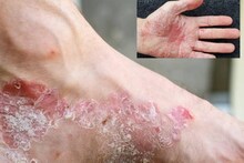 Psoriasis Symptoms: ফাটা গোড়ালি থেকে ঝরঝরিয়ে রক্ত! অবহেলা করবেন না! নিছক পা না ফেটে হতে পারে মারাত্মক সোরিয়াসিস! জানুন লক্ষণ!