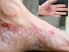 ফাটা গোড়ালি থেকে ঝরঝরিয়ে রক্ত! অবহেলা নয়! হতে পারে মারাত্মক সোরিয়াসিস! জানুন লক্ষণ