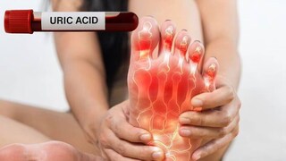 শরীরে ইউরিক অ্যাসিডের মাত্রা বেড়ে গেলে, এটি জয়েন্টের কাছে স্ফটিক আকারে জমা হতে শুরু করে