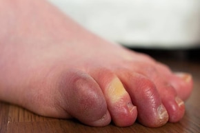 সরষের তেল, হলুদ দিয়ে ছোট্ট কাজেই কামাল! শীতে হাত-পা, আঙুল ফুলে ঢোল হওয়া থেকে মুক্তি!