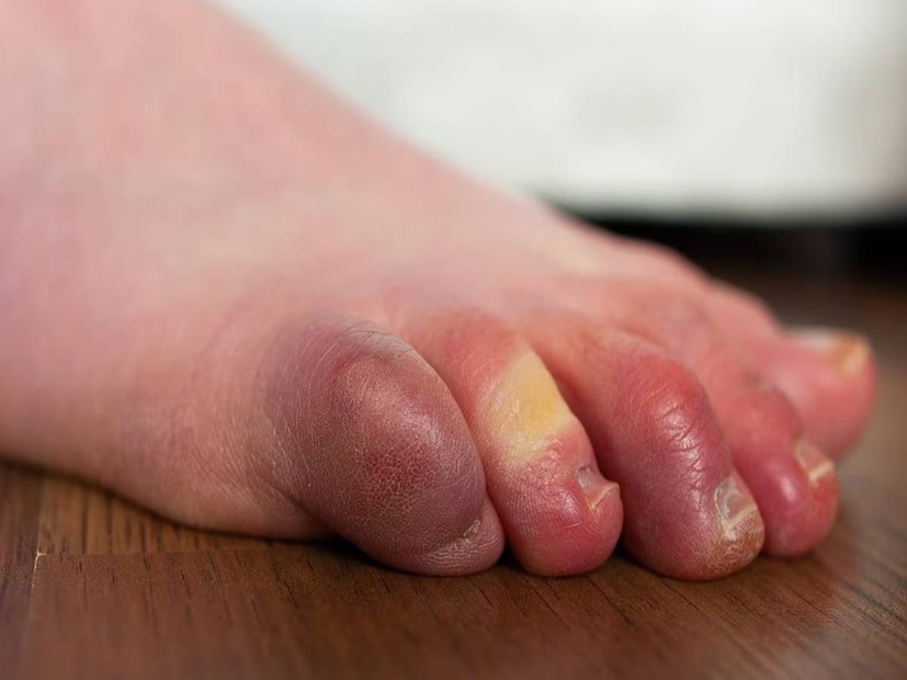 শীত শুরু হওয়ার সাথে সাথেই পুরুষ এবং মহিলা উভয়েরই একটি সাধারণ সমস্যার মুখোমুখি হতে হয়। শীতকালে হাত ও পা ফোলা একটি সাধারণ ঘটনা। কিছু ঘরোয়া প্রতিকারের মাধ্যমে বাড়িতেই এটি প্রতিরোধ করা যেতে পারে। উদাহরণস্বরূপ, হালকা গরম জলে শিলা লবণ দিয়ে একটি কম্প্রেস ভিজিয়ে রাখুন। বড় পাত্রে হালকা গরম জল নিন এবং এক মুঠো শিলা লবণ যোগ করুন। তারপর, আপনার হাত বা পা ১০-১৫ মিনিটের জন্য এতে ডুবিয়ে রাখুন। এতে ফোলাভাব এবং ব্যথা উভয়ই উপশম হবে।