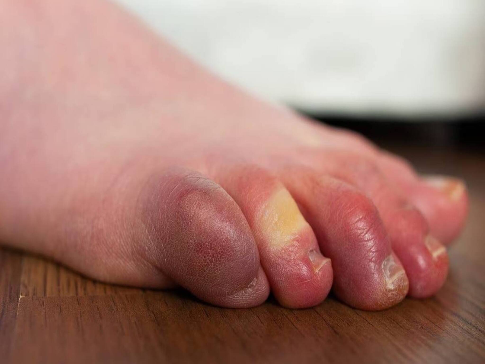 Swelling of Hands & Feet: সরষের তেল, হলুদ দিয়ে ছোট্ট কাজেই কামাল! শীতে হাত-পা, আঙুল ফুলে ঢোল হওয়া থেকে মুক্তি!