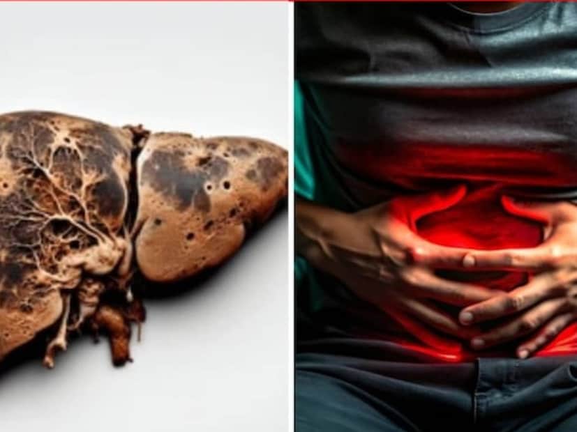 আমাদের লিভার হল শরীরের ডিটক্স সেন্টার। এটি এমন একটি অঙ্গ যা শরীর থেকে বিষাক্ত পদার্থ অপসারণ করে। তবে, যখন লিভারে চর্বি জমা হয়, তখন এটি ধীরে ধীরে কাজ করা বন্ধ করে দেয়। এই অবস্থাকে ফ্যাটি লিভার বলা হয়, যা সময়মতো সমাধান না করা হলে সিরোসিস বা লিভার ফেইলিওরের মতো গুরুতর রোগের কারণ হতে পারে।