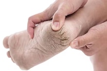 Vitamin Deficiency to cause Cracked Heels: খেতে হবে পালং শাক, বাদাম, পেয়ারা... কোন ভিটামিনের অভাবে শীতে গোড়ালি ফাটে জানুন!