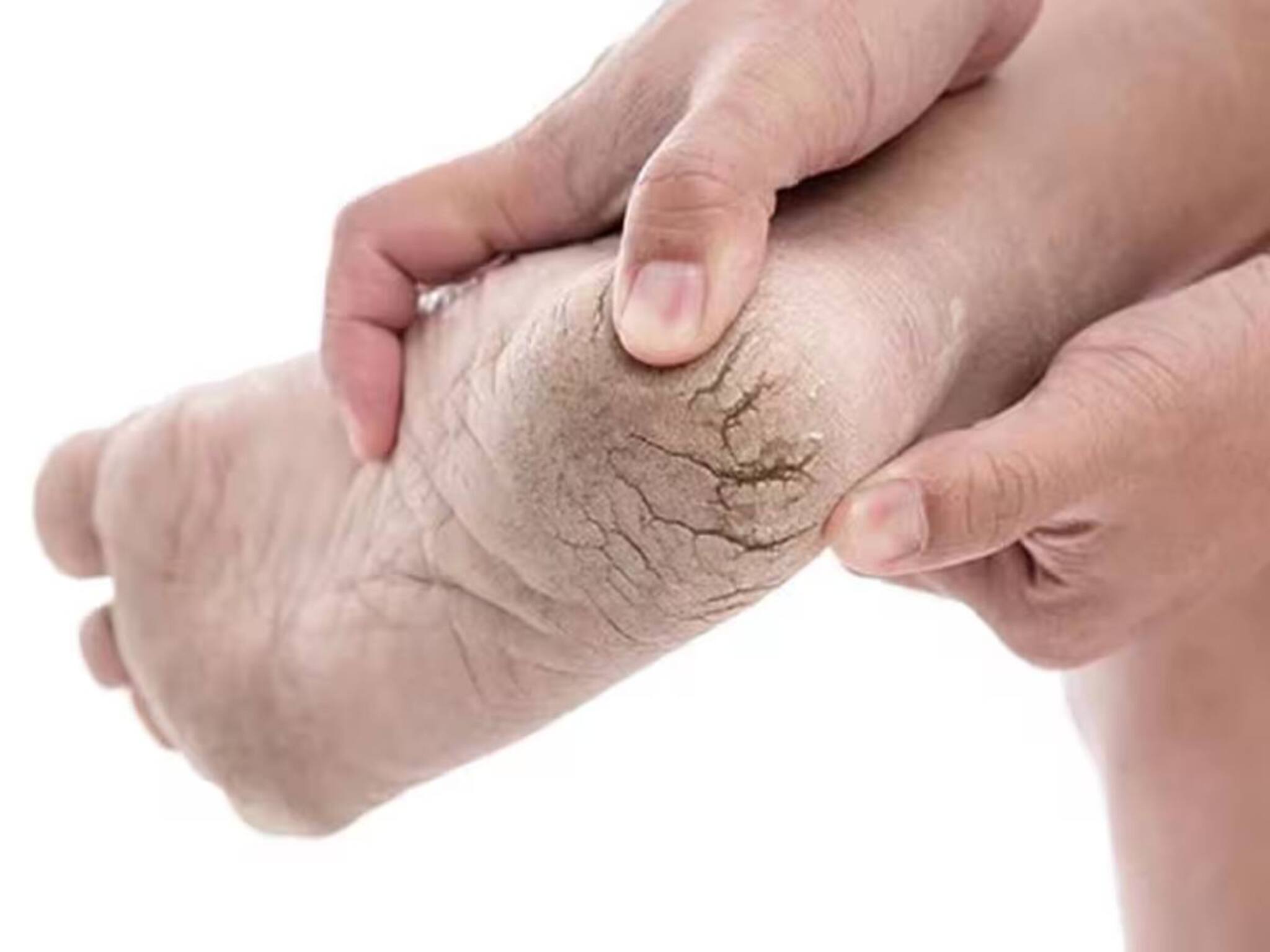 Vitamin Deficiency to cause Cracked Heels: খেতে হবে পালং শাক, বাদাম, পেয়ারা... কোন ভিটামিনের অভাবে শীতে গোড়ালি ফাটে জানুন!