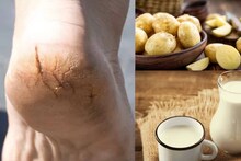 Cracked Heels Remedies: দামি ফুট ক্রিম মাখার দরকারই নেই! ১ টা আলু আর দুধেই মসৃণ হবে ফুটিফাটা গোড়ালি! সস্তায় সারান শীতের ফাটা পায়ের সমস্যা!