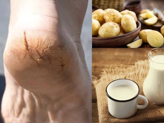 দামি ফুট ক্রিম বাদ দিন! ১ টা আলু আর দুধেই মসৃণ হবে ফুটিফাটা গোড়ালি! সস্তায় সারান পা ফাটা