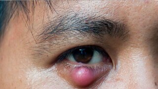 চোখে আঞ্জনি (ফাইল ছবি) চোখে আঞ্জনি (ফাইল ছবি)