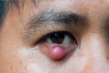 আঞ্জনি বা আইলিড সিস্ট খুবই কষ্টকর এক রোগ, কী করলে চটজলদি আরাম পাবেন জানুন