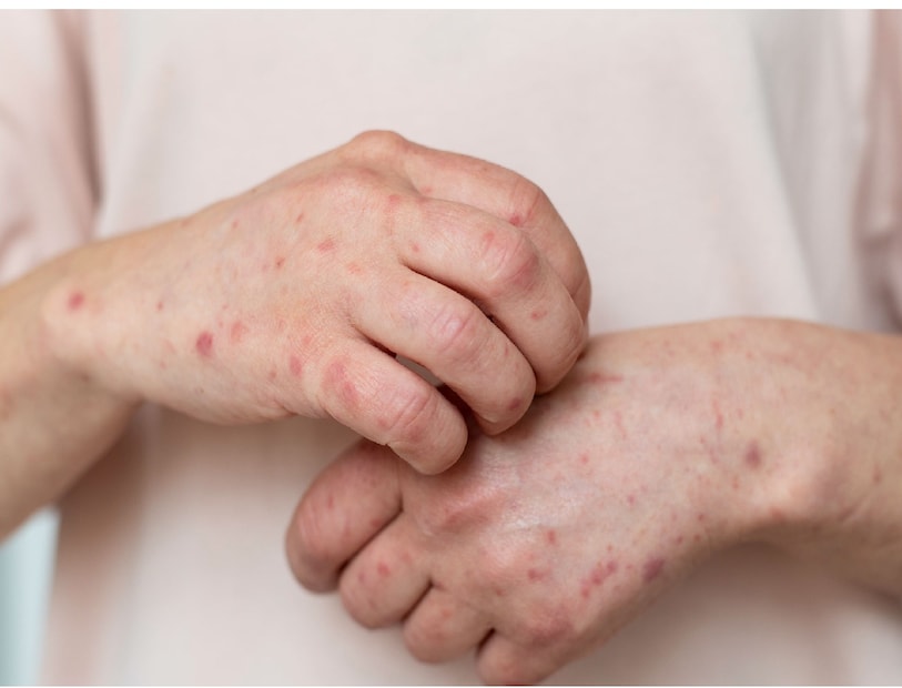 সোরিয়াসিস ত্বকের প্রদাহজনিত একটি অসুখ। বিশ্বের লাখ-লাখ মানুষ এই রোগে আক্রান্ত। এই অসুখে শরীরের বিভিন্ন অংশে গোলাকার, এবড়োখেবড়ো চাকার মতো দাগ তৈরি হয়। আক্রান্ত অংসের ত্বক থেকে মাছের আঁশের মতো খোসা উঠতে থাকে। জায়গাটা খসখসে হয়ে যায়, চুলকাতে থাকে, ধীরে ধীরে আক্রান্ত স্থানের রং বদলে লালচে বা কালচে আকার নেয়। রোগ বাড়লে অনেক সময়েই আক্রান্ত স্থান থেজে রক্ত বা পুঁজ বার হয়।  সোরিয়াসিস ত্বকের প্রদাহজনিত একটি অসুখ। বিশ্বের লাখ-লাখ মানুষ এই রোগে আক্রান্ত। এই অসুখে শরীরের বিভিন্ন অংশে গোলাকার, এবড়োখেবড়ো চাকার মতো দাগ তৈরি হয়। আক্রান্ত অংসের ত্বক থেকে মাছের আঁশের মতো খোসা উঠতে থাকে। জায়গাটা খসখসে হয়ে যায়, চুলকাতে থাকে, ধীরে ধীরে আক্রান্ত স্থানের রং বদলে লালচে বা কালচে আকার নেয়। রোগ বাড়লে অনেক সময়েই আক্রান্ত স্থান থেজে রক্ত বা পুঁজ বার হয়।