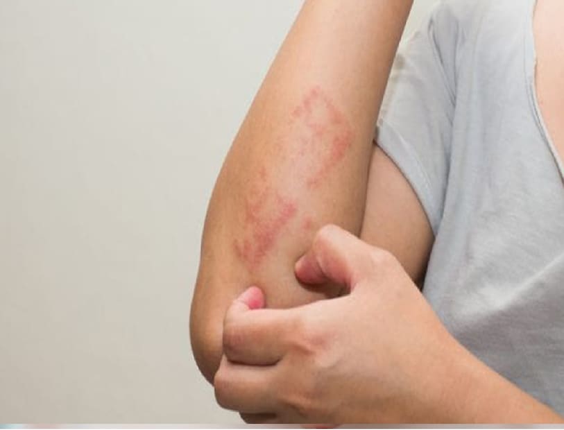 বিশ্ব স্বাস্থ্য সংস্থা (WHO, 2023) এবং ইন্টারন্যাশনাল ফেডারেশন অফ সোরিয়াসিস অ্যাসোসিয়েশনস (IFPA)-এর তথ্য অনুযায়ী, সোরিয়াসিসে বিশ্ব জনসংখ্যার প্রায় ২–৩% মানুষ আক্রান্ত, অর্থাৎ সারা বিশ্বে প্রায় ১২.৫ কোটিরও বেশি মানুষ এই রোগে ভুগছেন। যদিও শুধুমাত্র খাদ্যাভ্যাস সোরিয়াসিসের কারণ নয়, তবুও কিছু নির্দিষ্ট খাবার শরীরে প্রদাহ বৃদ্ধি করতে পারে। চকোলেট, কফি ও ঝাল খাবার কি সোরিয়াসের ঝুঁকি বাড়িয়ে দেয়?