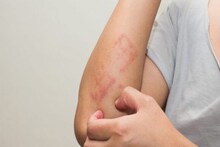 Psoriasis: ভয়ঙ্কর ত্বকের অসুখ 'সোরিয়াসিস', কোন কোন খাবার এই অসুখের ঝুঁকি বাড়িয়ে দেয়? পড়ুন