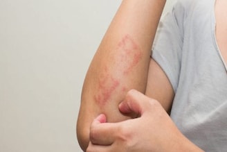 ভয়ঙ্কর ত্বকের অসুখ 'সোরিয়াসিস', কোন কোন খাবার এই অসুখের ঝুঁকি বাড়িয়ে দেয়?