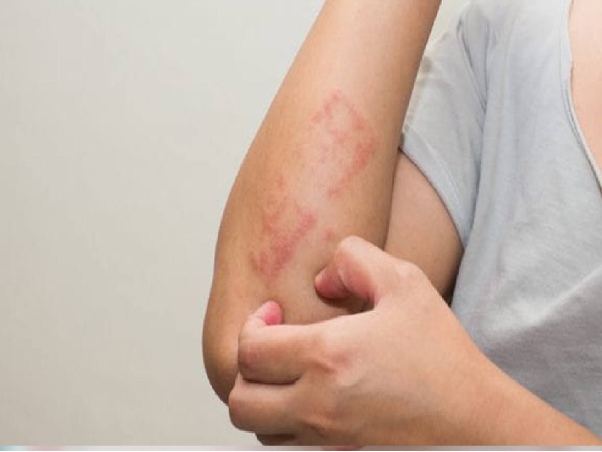 Psoriasis: ভয়ঙ্কর ত্বকের অসুখ 'সোরিয়াসিস', কোন কোন খাবার এই অসুখের ঝুঁকি বাড়িয়ে দেয়? পড়ুন