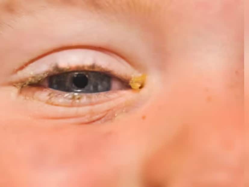 শুষ্কতা বাড়লে চোখ নিজেকে রক্ষা করার জন্য মোটা মিউকাস তৈরি করে, যা রাতভর জমে কাদার মতো রূপ নেয়। এতে অনেক সময় চোখে চুলকানি বা গুরুতর ক্ষেত্রে ঝাপসা দেখা দেওয়ার মতো সমস্যাও বাড়তে পারে।