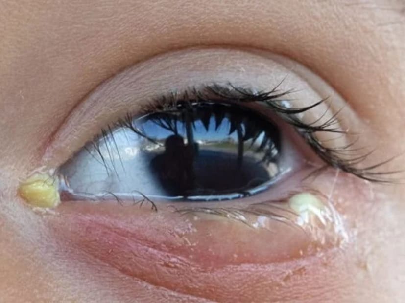 কিন্তু সাধারণ পিচুটিই সমস্যা সৃষ্টি করতে পারে৷ অথবা হতে পারে দেহের অন্দরে চলতে থাকা কোনও সমস্যার সঙ্কেত৷ স্বাভাবিকের চেয়ে অতিরিক্ত পরিমাণ পিচুটি কোন ভিটামিনের অভাবে কেন হয় সে বিষয়ে জানালেন চিকিৎসক৷