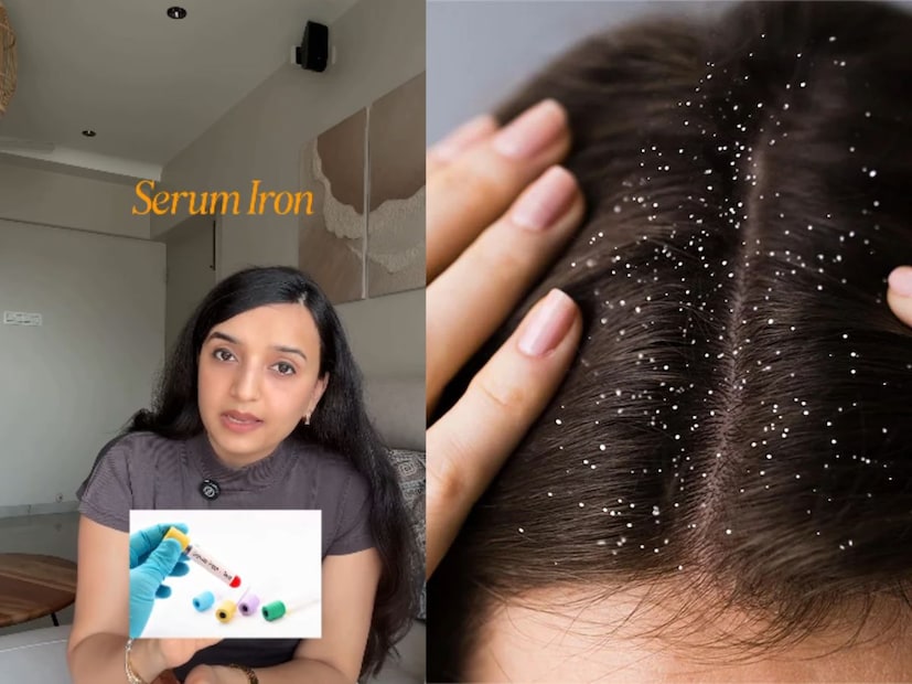 সম্প্রতি বিখ্যাত নিউট্রিশনিস্ট শ্বেতা শাহ পাঁচাল তার ইনস্টাগ্রাম হ্যান্ডেলে একটি ভিডিও শেয়ার করেছেন। পুষ্টিবিদ জানিয়েছেন যে ঠিক কী কারণে হয় খুশকির সমস্যা৷ পাশাপাশি খুশকিকে পাকাপাকিভাবে বিদায় জানাবার সেরা এবং সঠিক উপায়ও জানালেন তিনি৷ 