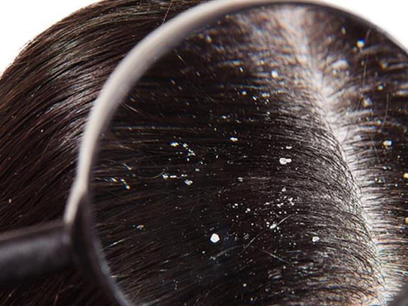 খুশকির সমস্যার জন্য মূলত কোন ভিটামিন দায়ীশ্বেতা শাহ পাঁচালের মতে, ভিটামিন B6, B12 এবং বায়োটিন স্ক্যাল্পের স্বাস্থ্যে বড় ভূমিকা পালন করে। এর ঘাটতির কারণে চুলের সঙ্গে সম্পর্কিত সমস্যা, বিশেষ করে ড্যান্ড্রফের সমস্যা বেড়ে যায়। এমন অবস্থায় একবার এই ভিটামিনগুলির পরীক্ষা করান। এরপর প্রয়োজন হলে আপনি বিশেষজ্ঞের পরামর্শে ভিটামিন B6 এবং B12-এর সাপ্লিমেন্ট নিতে পারেন।