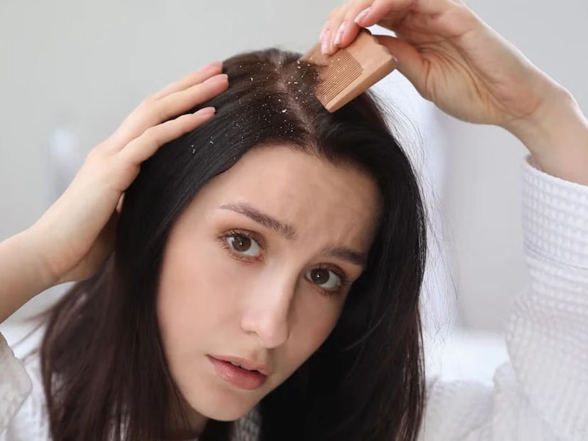 নাছোড়বান্দা এই ফাঙ্গাসকে মাথা থেকে তাড়ানো ভারী দু:ষ্কর। মাথা চুলকোতে থাকে। হাজারো রকমের শ&#x200d;্যাম্পু, তেল ব&#x200d;্যবহার করার পরেও বিদায় নিতে চায় না খুশকি। উল্টে অনেকের ক্ষেত্রেই দামি দামি কেমিক&#x200d;্যালের কারণে চুলের সমস্যা আরও বেড়ে যায়৷ 