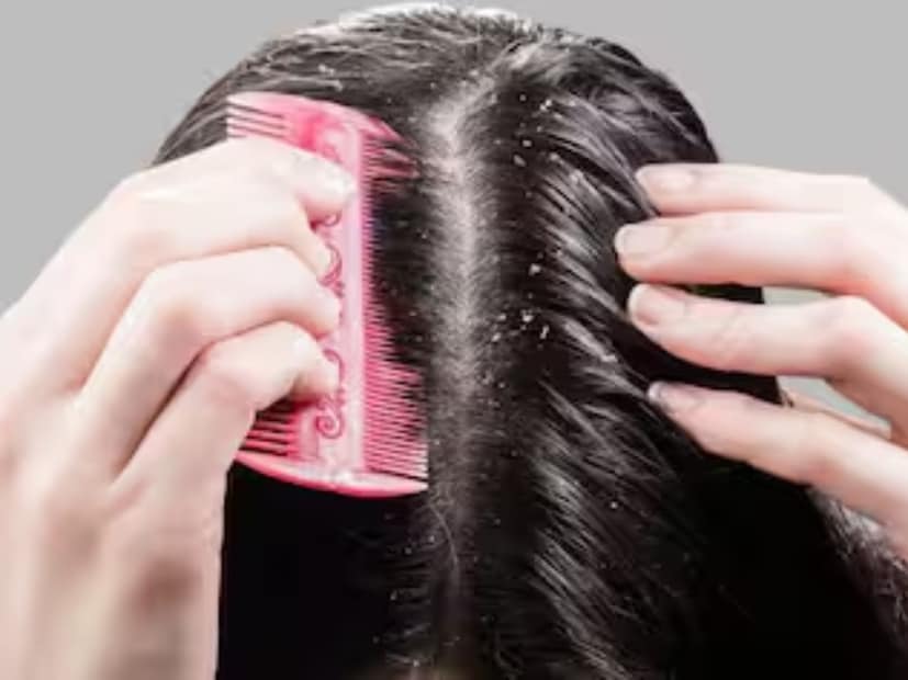 চিনি এবং রিফাইন্ড কার্বসের পরিমাণ কমানপুষ্টি বিশেষজ্ঞ বলেন, বেশি চিনি ফাঙ্গাল গ্রোথ বাড়ায়, যার ফলে ড্যান্ড্রফ আরও গুরুতর হতে পারে। এমন অবস্থায় ময়দা, মিষ্টি জিনিস এবং প্রক্রিয়াজাত খাবার যতটা সম্ভব কম খান।
