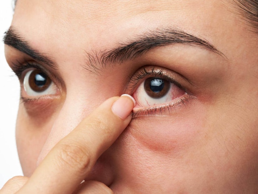 এর ফলে নিয়মিত, ব্যাপক চক্ষু পরীক্ষা, বিশেষ করে বার্ষিক চোখের পরীক্ষা ডায়াবেটিস ম্যানেজমেন্টের একটি অপরিহার্য অংশ হয়ে ওঠে। ভারতে যেখানে ডায়াবেটিসের প্রকোপ দ্রুত বৃদ্ধি পাচ্ছে, এই ধরনের সচেতনতা কেবল সময়োপযোগীই নয়, বরং দীর্ঘমেয়াদী চোখের স্বাস্থ্য রক্ষার জন্যও গুরুত্বপূর্ণ। বিষয়টি ব্যাখ্যা করছেন দিশা আই হসপিটালের সিনিয়র কনসালটেন্ট, ভিট্রিও-রেটিনা এবং ইউভিয়া ডা. শান্তনু মণ্ডল।