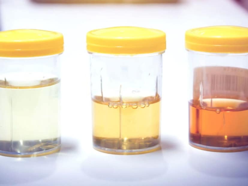 ত্বকের বিভিন্ন সমস&#x200d;্যা থেকে প্রস্রাব, মল, দেহের রেচন পদার্থে দেখা যায় শরীরের মধ&#x200d;্যে চলতে থাকা সমস&#x200d;্যার লক্ষণ। নিজের প্রস্রাবে কয়েকটি লক্ষণ দেখলে তখনই সতর্ক হয়ে যান, আপনার শরীরের অন্দরে বাসা বেঁধেছে ডায়াবেটিস।