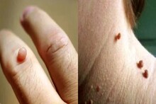 Mole or Wart on Skin: শরীরে আঁচিল খুবই সাধারণ, এটি এক মারণরোগের লক্ষণ হতে পারে! সময় থাকতেই সতর্ক হওয়া জরুরি