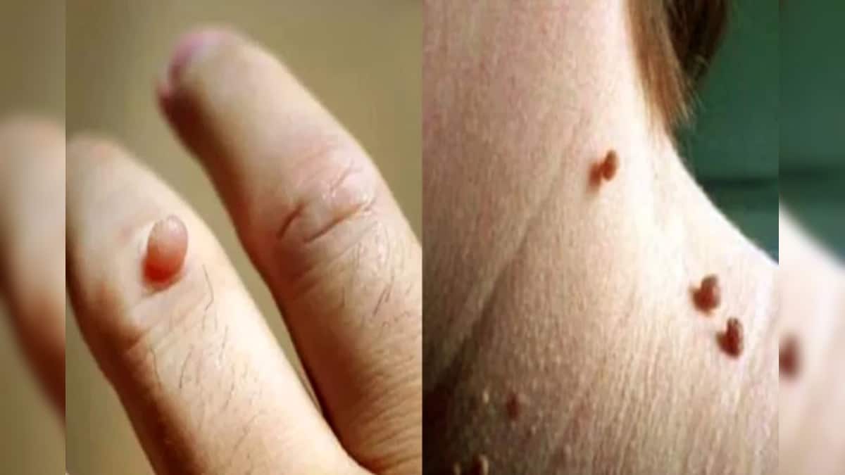 Mole or Wart on Skin: আপনার শরীরে আঁচিল আছে? আঁচিল কী, কেন হয়? এক মারণরোগের লক্ষণ হতে পারে, সময় থাকতেই সতর্ক হওয়া জরুরি Mole or Wart on Skin: আপনার শরীরে আঁচিল আছে? আঁচিল কী, কেন হয়? এক মারণরোগের লক্ষণ হতে পারে, সময় থাকতেই সতর্ক হওয়া জরুরি