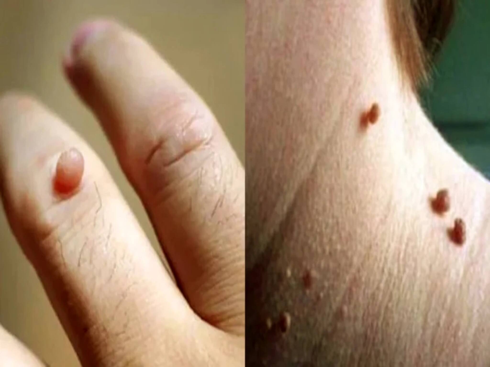 Mole or Wart on Skin: শরীরে আঁচিল খুবই সাধারণ, এটি এক মারণরোগের লক্ষণ হতে পারে! সময় থাকতেই সতর্ক হওয়া জরুরি