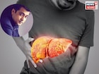 লিভার সিরোসিসে মৃত্যু অভিনেতার, কোন লক্ষণে বুঝবেন আপনার শরীরে বাসা বেঁধেছে এই কঠিন রোগ