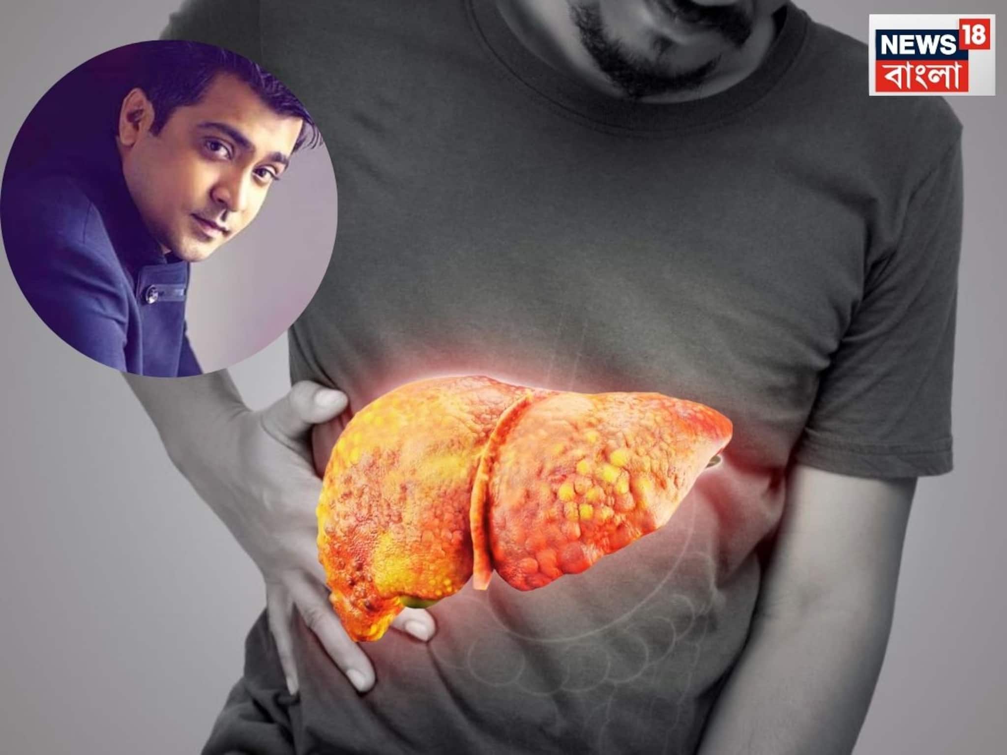 Liver Cirrhosis: লিভার সিরোসিসে মৃত্যু দক্ষিণী অভিনেতা অভিনয়ের, হঠাৎ ওজন কম হওয়া ছাড়া আর কোন কোন উপসর্গ বুঝিয়ে দেবে আপনার শরীরে এই কঠিন রোগ বাসা বেঁধেছে