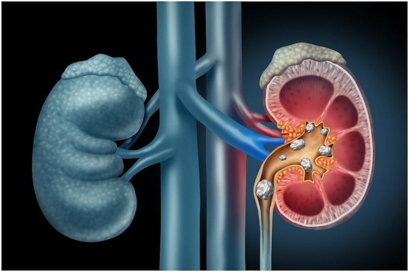 অতএব, যদি আপনি কিডনিতে পাথরের সমস্যায় ভুগছেন, তাহলে আপনার খাদ্যাভ্যাসের প্রতি বিশেষ মনোযোগ দিন। প্রচুর জল পান করুন। এই সমস্যা এড়াতে, বাইরের খাবার এড়িয়ে চলুন এবং ক্যালসিয়ামবিহীন খাবার খান।