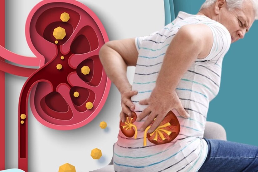 ডাঃ প্রবীণ কুমার মাধেশিয়া ব্যাখ্যা করেন যে তাঁর কাছে ২০ থেকে ২৫ জন রোগী আছেন যাদের কিডনিতে পাথরের কারণে কিডনি ক্ষতিগ্রস্ত হয়েছে এবং যারা ডায়ালিসিসে আছেন। এই সামান্য অবহেলা গুরুতর সমস্যা তৈরি করতে পারে। 