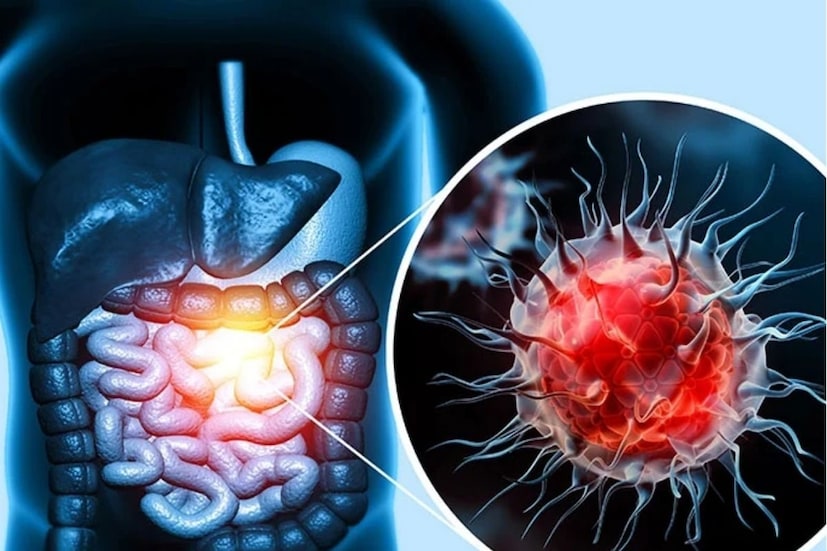ক্রমবর্ধমান গবেষণার মাধ্যমে কোলনের স্বাস্থ্যের সাথে অন্ত্রের মাইক্রোবায়োম - পরিপাকতন্ত্রে বসবাসকারী কোটি কোটি ব্যাকটেরিয়া - এর সংযোগ খুঁজে পাওয়া যাচ্ছে। এই নাজুক বাস্তুতন্ত্রের ব্যাঘাত, যা প্রায়শই খারাপ খাদ্যাভ্যাস, অ্যান্টিবায়োটিক এবং পরিবেশ দূষণের কারণে ঘটে, প্রদাহ এবং এমনকি জেনেটিক পরিবর্তনের কারণ হতে পারে। 