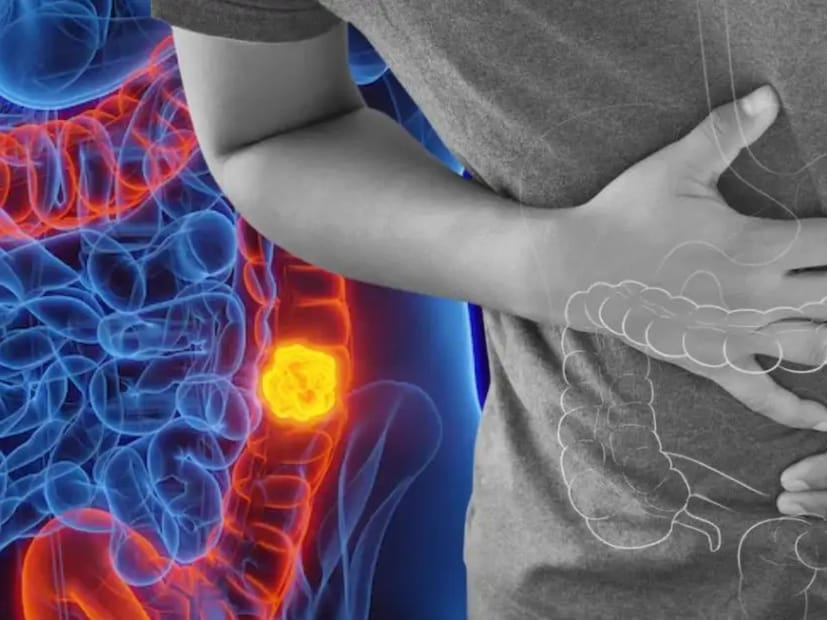 যদিও জেনেটিক্স পরিবর্তন করা যায় না, জীবনধারা এবং সচেতনতা একটি শক্তিশালী পরিবর্তন আনতে পারে। প্রাথমিক পর্যায়ে কোলন ক্যানসারের সংখ্যা বৃদ্ধি পাচ্ছে, তাই এটা স্পষ্ট যে প্রতিরোধ, সতর্কতা এবং সময়োপযোগী পদক্ষেপই এই ক্রমবর্ধমান স্বাস্থ্য উদ্বেগের বিরুদ্ধে সর্বোচ্চ প্রতিরক্ষা।