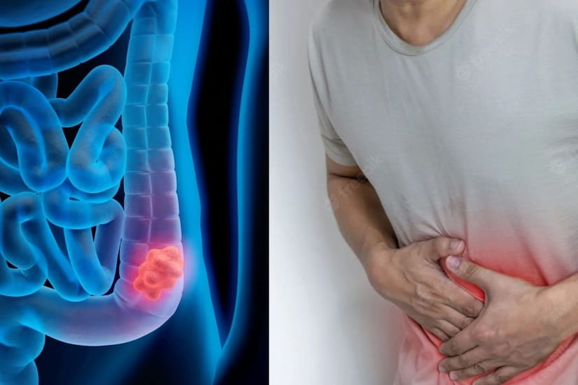  "খাদ্যতালিকা এবং জীবনযাত্রার অভ্যাসের উল্লেখযোগ্য পরিবর্তন এই বৃদ্ধির পিছনে একটি প্রধান কারণ। আমাদের খাদ্যতালিকাগুলি প্রক্রিয়াজাত এবং অতি-প্রক্রিয়াজাত খাবারের দিকে ব্যাপকভাবে সরে গেছে যেখানে চিনি এবং অস্বাস্থ্যকর চর্বি বেশি, অন্যদিকে খাদ্যতালিকাগত ফাইবার খুব কম," বলেছেন দিল্লির সিকে বিড়লা হাসপাতালের সার্জিক্যাল অনকোলজির পরিচালক ডঃ মনদীপ সিং মালহোত্রা।