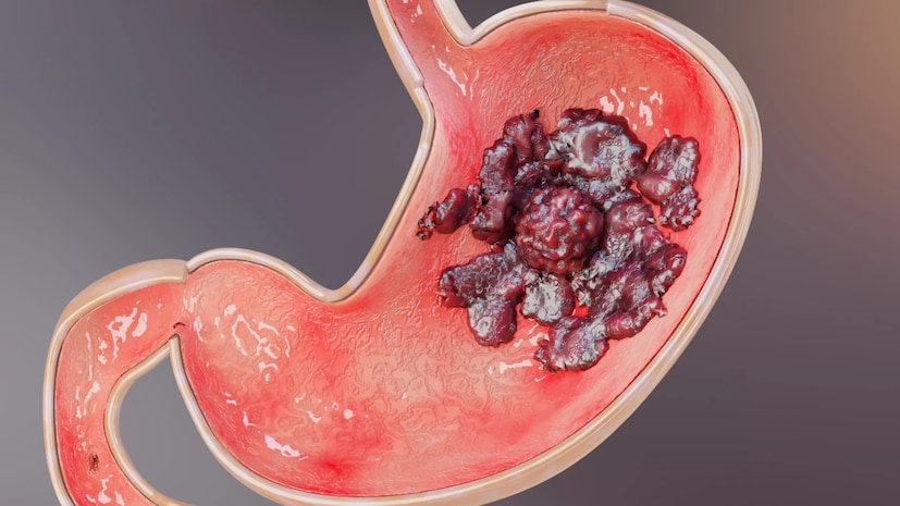 তামাক এবং অ্যালকোহল সেবন : সিগারেট এবং অ্যালকোহলের মতো পদার্থের প্রতি আসক্তি পাকস্থলীর প্রতিরক্ষামূলক আস্তরণকে দুর্বল করে দেয়, যার ফলে আলসার আরও সহজে তৈরি হয়। কম ঘুম এবং বিশ্রামের অভাব: যখন শরীর পর্যাপ্ত বিশ্রাম নেয় না, তখন এটি নিজেকে মেরামত করতে পারে না, যার ফলে পাকস্থলী আরও দুর্বল অবস্থায় পড়ে।