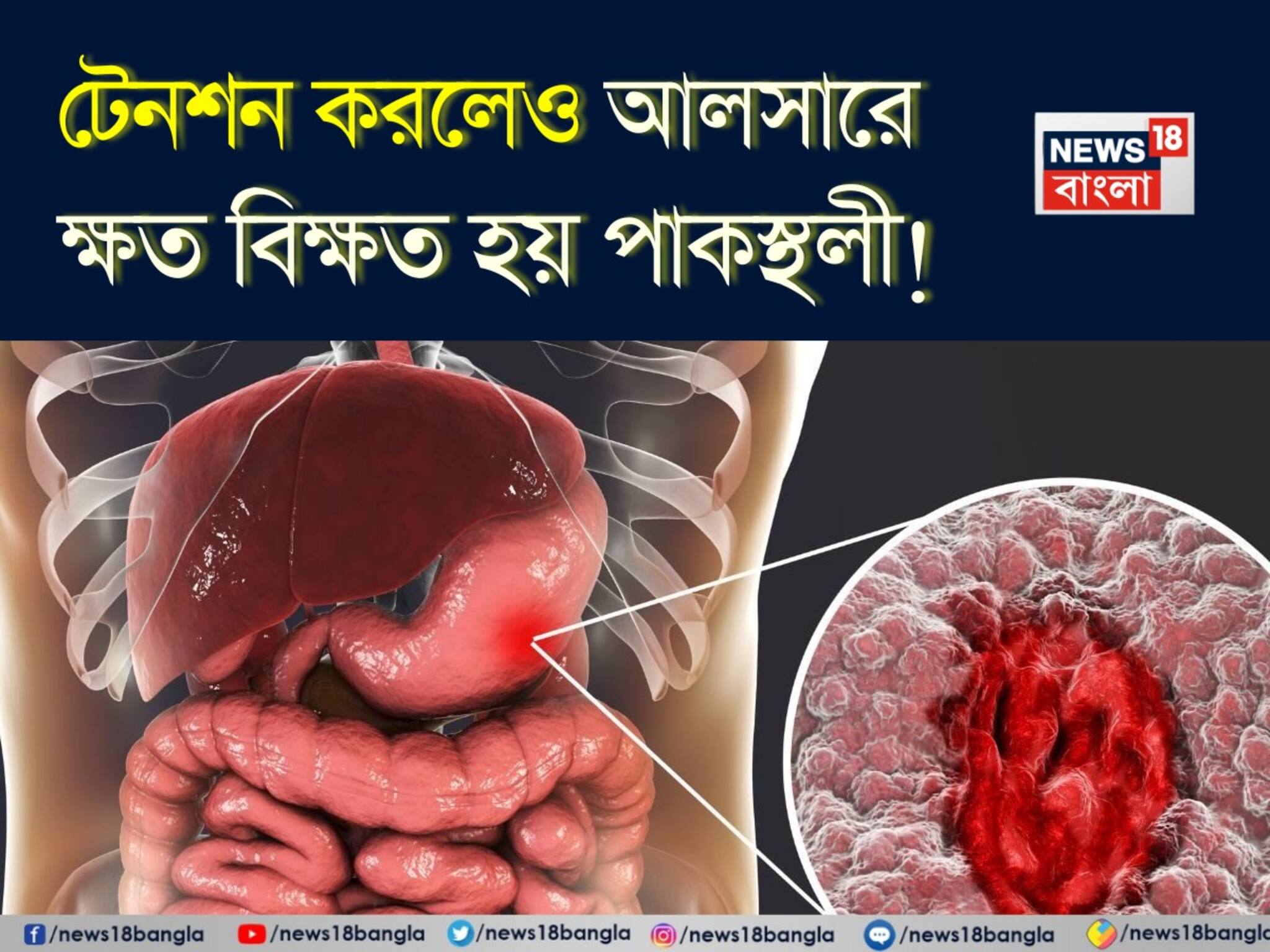 Peptic Ulcer: শুধুই নয় মশলাদার খাবার! একটানা অনেক দিন টেনশন করলেও আলসারে ক্ষত বিক্ষত হয় পাকস্থলী! সতর্ক করলেন বিশেষজ্ঞ ডাক্তার!