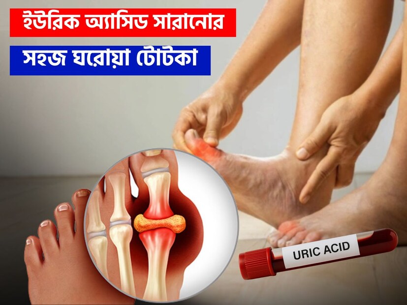 ইউরিক অ্যাসিড বৃদ্ধির সমস্যা এখন সাধারণ হয়ে উঠেছে। অনেক তরুণ-তরুণী উচ্চ ইউরিক অ্যাসিডের সমস্যায় ভুগছেন। ইউরিক অ্যাসিড আমাদের শরীরে উৎপাদিত একটি বর্জ্য পদার্থ। এটি অতিরিক্ত পরিমাণে উৎপাদিত হলে, এটি শরীরের জয়েন্টগুলিতে জমা হয় এবং ছোট ছোট স্ফটিক তৈরি করে। এটি গাউট নামক আর্থ্রাইটিসের ঝুঁকি বাড়ায়। ইউরিক অ্যাসিড বৃদ্ধির ফলে পা, হাঁটু এবং হাতের জয়েন্টগুলিতে ফোলাভাব, ব্যথা এবং জ্বালাপোড়া হতে পারে। ওষুধের পাশাপাশি কিছু সহজ পদ্ধতি অবলম্বন করলে, প্রাকৃতিকভাবে ইউরিক অ্যাসিড কমানো সম্ভব। বলছেন পুষ্টিবিদ সোনিয়া নারাং৷