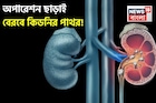 অস্ত্রোপচার ছাড়াই প্রস্রাবের সঙ্গে বেরবে কিডনির পাথর! কীভাবে, জানুন! বলছেন বিশেষজ্ঞ