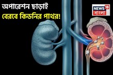 Kidney Stone Cleaning: অস্ত্রোপচার ছাড়াই প্রস্রাবের সঙ্গে বেরবে কিডনির পাথর! কীভাবে, জানুন! বলছেন বিশেষজ্ঞ