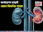অস্ত্রোপচার ছাড়াই প্রস্রাবের সঙ্গে বেরবে কিডনির পাথর! কীভাবে, জানুন! বলছেন বিশেষজ্ঞ